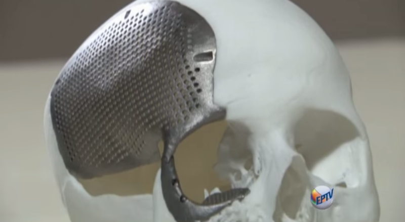 Illustration for article titled Surgeons In Brazil Successfully Implant A 3D-Printed Titanium Skull